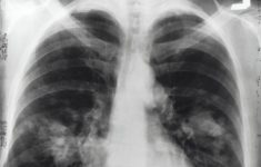 Генетические мутации вызывают опухоли лёгких у некурящих