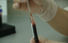 ДНК-тест позволит предотвратить сотни тысяч инсультов