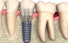 Что такое имплантация зубов All-on-6, история появления метода, преимущества и в каких случаях применяется?