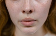 Синдром поликистозных яичников: ранний признак можно увидеть на лице